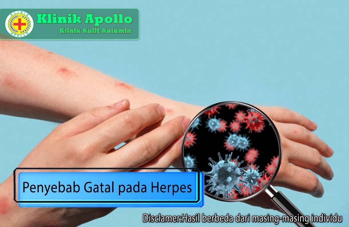 Lakukan pemeriksaan dengan dokter ahli di klinik untuk mengetahui penyebab gatal pada herpes dan obati.