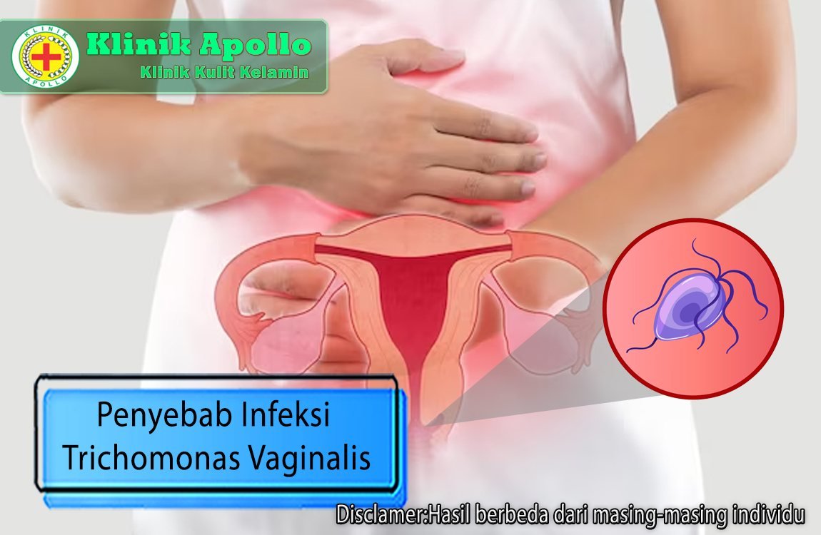 Dengan mengetahui penyebab infeksi trichomonas vaginalis dapat mempermudah penanganan selanjutnya.