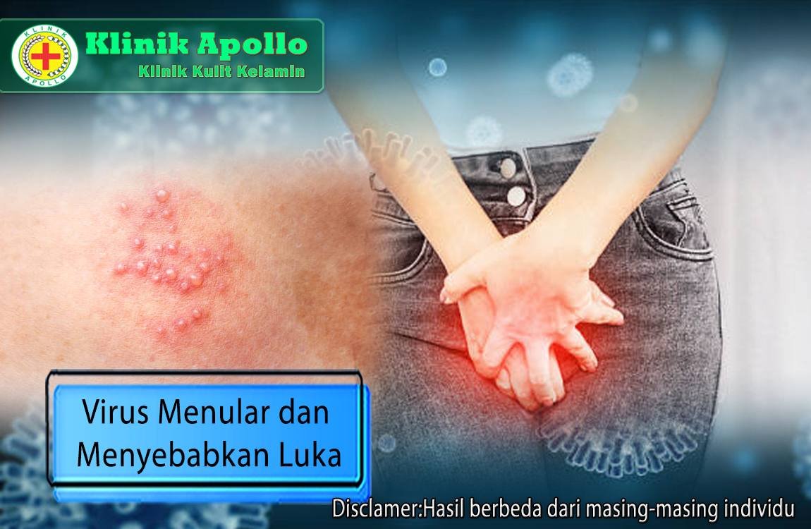 Virus menular dan menyebabkan luka pada kulit dapat Anda ketahui melalui pemeriksaan medis.