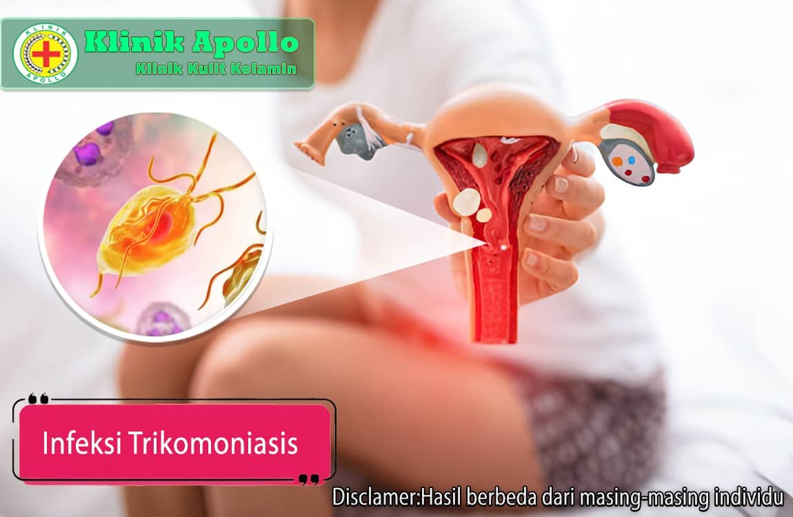 Infeksi trikomoniasis dapat disembuhkan dengan penanganan yang tepat di Klinik Apollo Jakarta.
