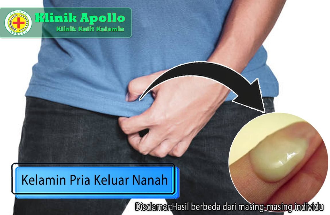 Percayakan penanganan perihal kelamin pria keluar nanah hanya di Klinik Apollo.