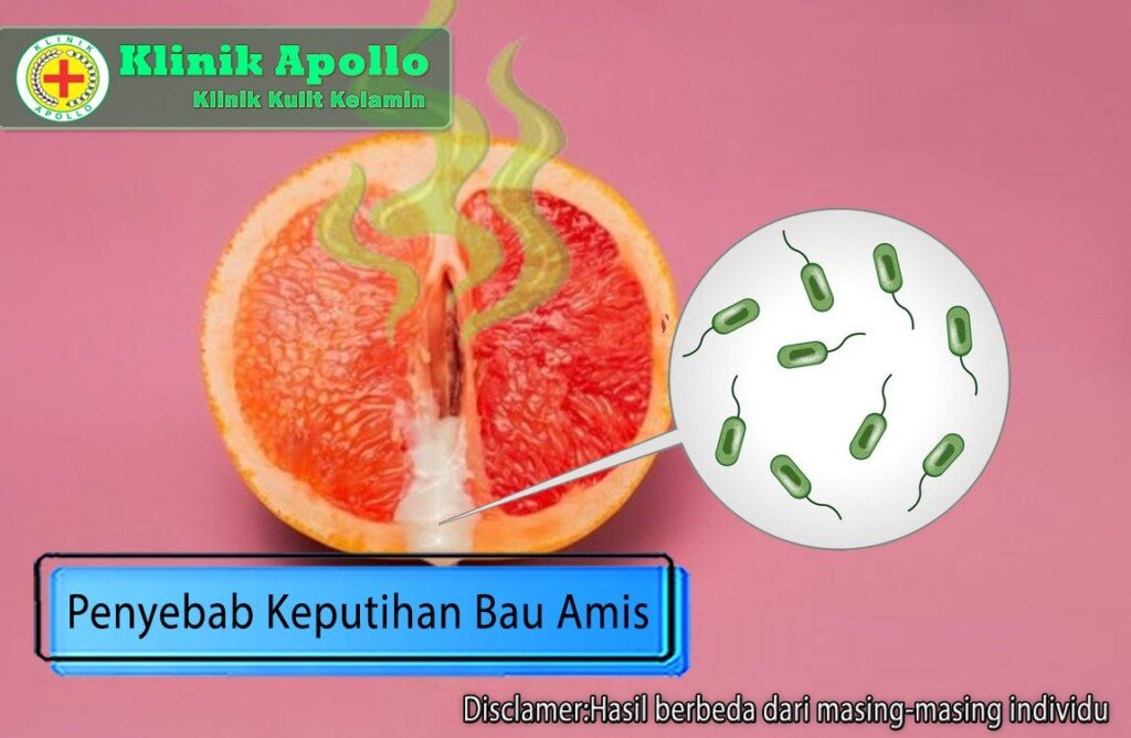 Ungkap Penyebab Keputihan Berbau Amis Yang Perlu Diketahui Klinik