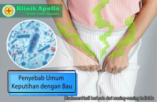 Penyebab Keputihan Bau Dan Bagaimana Cara Mengatasinya Klinik Apollo