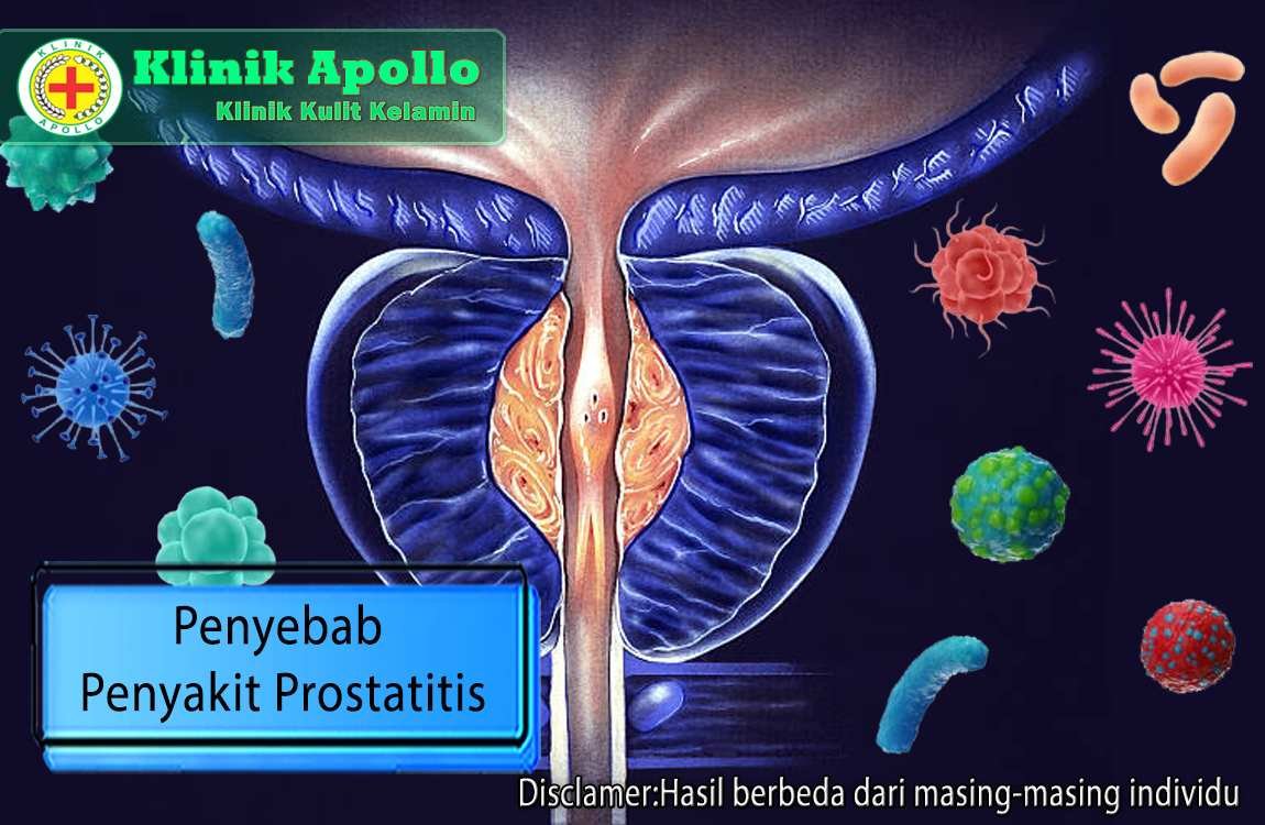 Untuk mengetahui penyebab penyakit prostatitis adalah dengan cara melakukan pemeriksaan medis.