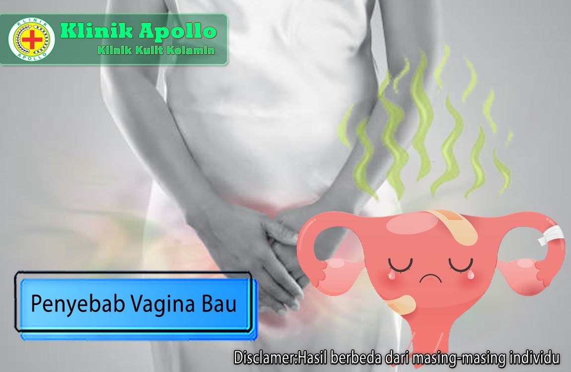 Untuk mengetahui penyebab vagina bau pada wanita adalah dengan cara melakukan pemeriksaan medis dengan dokter ahli.