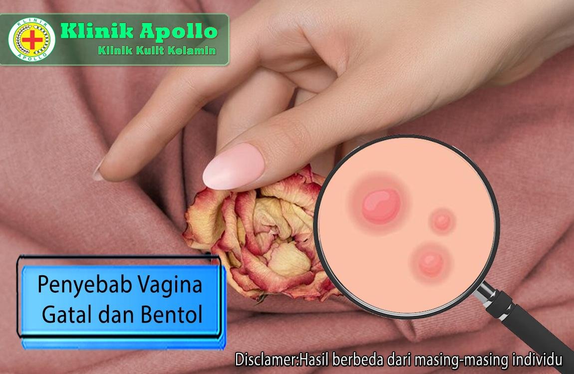 Ketahui penyebab vagina gatal dan bentol dengan pemeriksaan medis di Klinik Apollo.