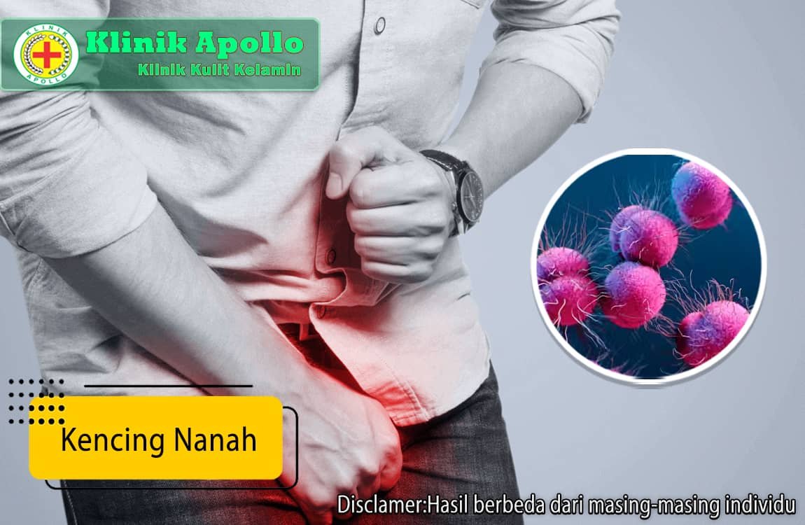 Kencing Nanah dapat disembuhkan dengan pengobatan di Klinik Apollo Jakarta.
