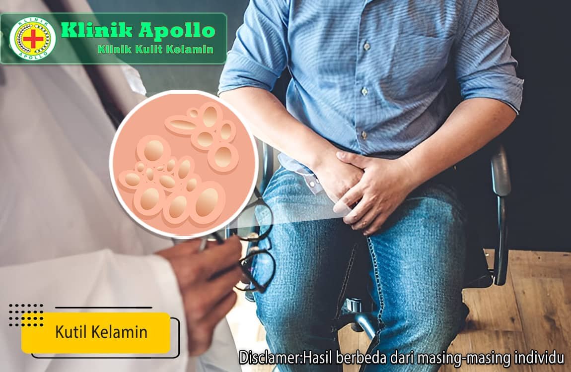 Percayakan penanganan kutil kelamin yang Anda alami hanya di Klinik Apollo Jakarta.