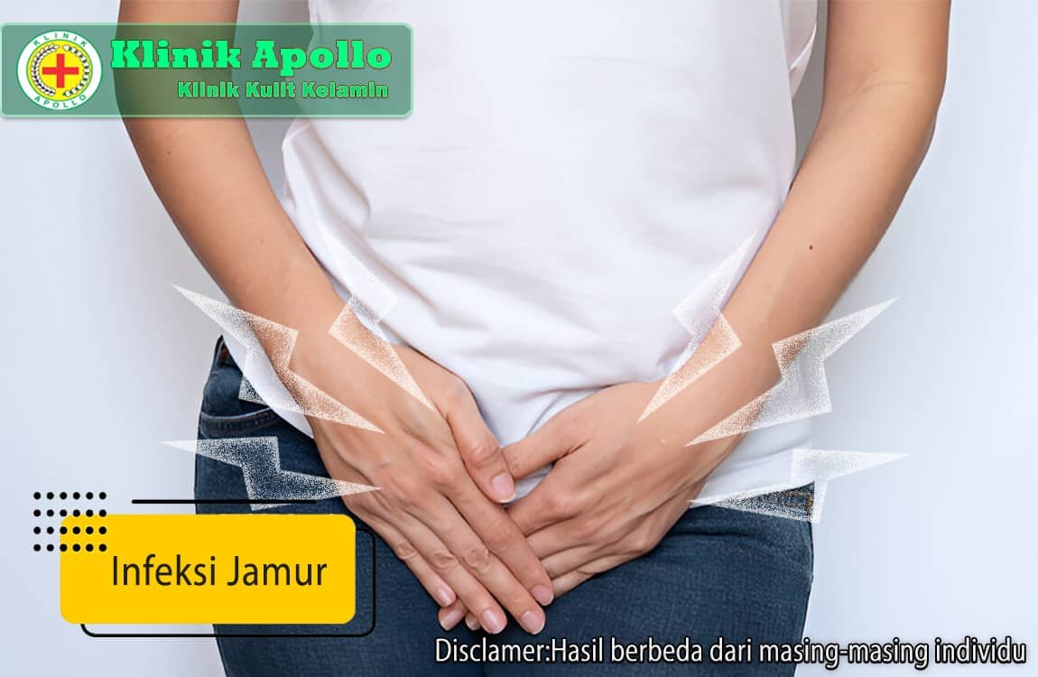 Tidak perlu khawatir, infeksi jamur dapat diatasi dengan cepat hanya di Klinik Apollo Jakarta.