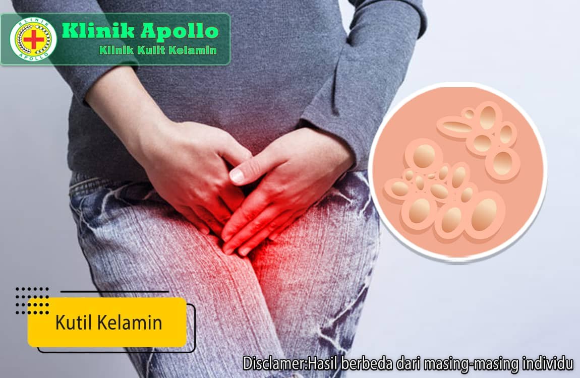 Kutil kelamin ini dapat dengan mudah ditangani dengan penanganan yang tepat oleh dokter ahli di Klinik Apollo.