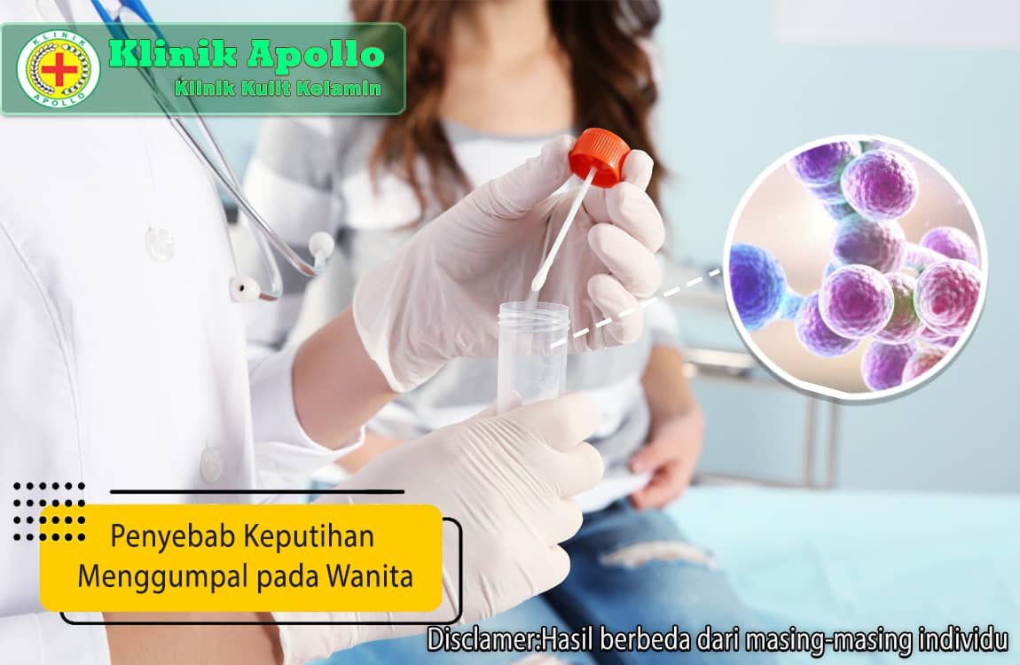 Untuk mengetahui penyebab keputihan menggumpal pada wanita dalah dengan cara melakukan pemeriksaan medis.