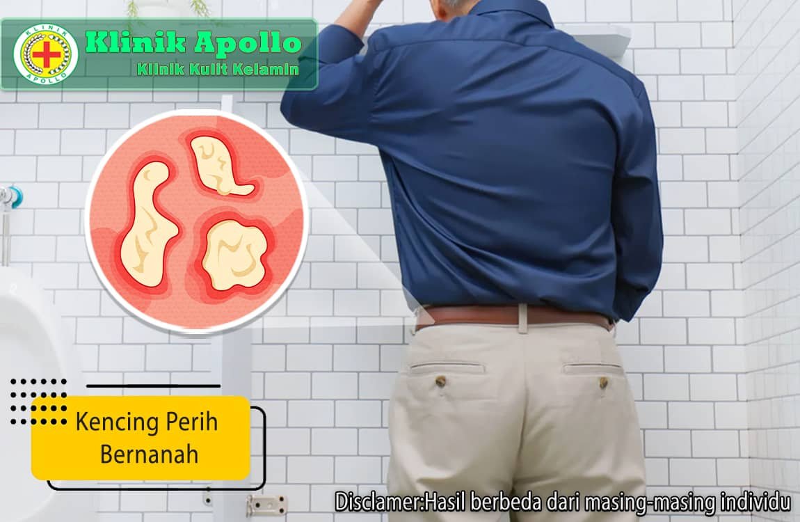 Mengalami kondisi seperti kencing perih bernanah membutuhkan penanganan medis segera di Klinik Apollo.