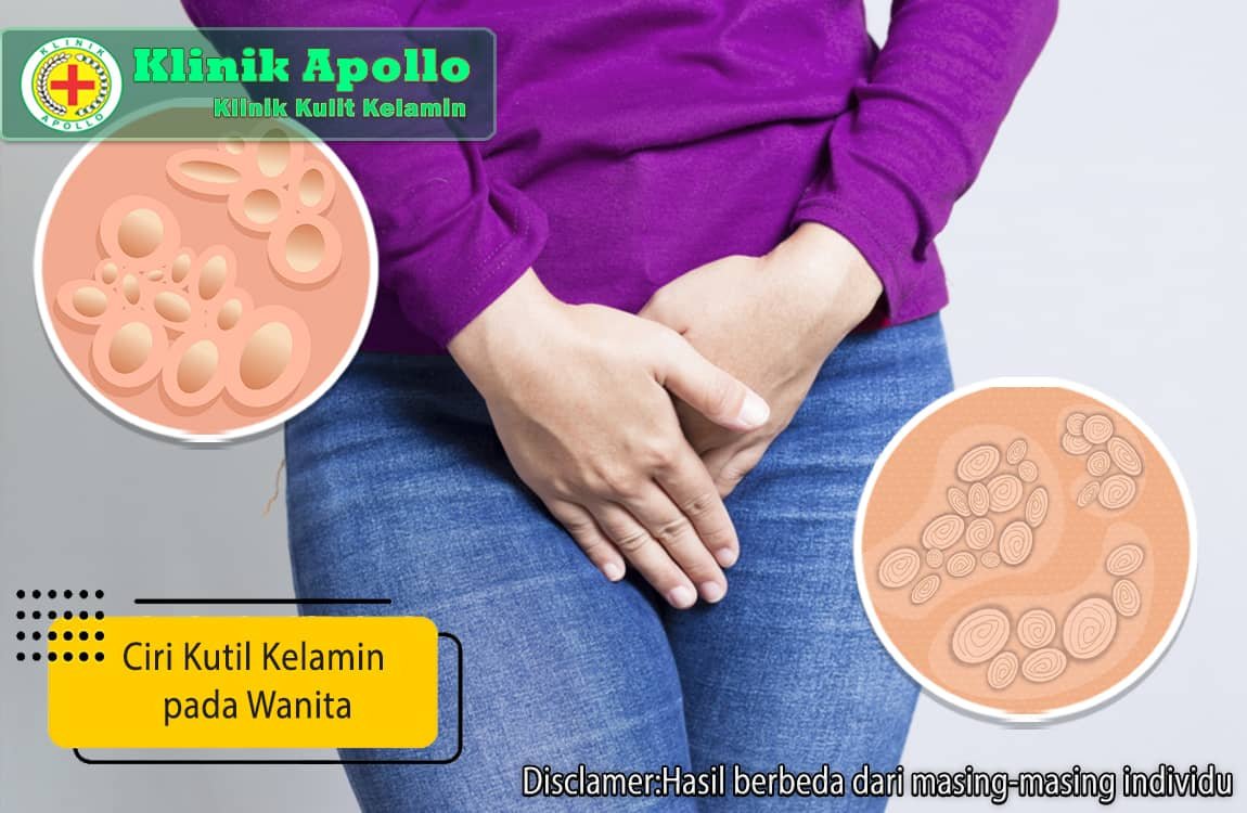 Kenali ciri kutil kelamin pada wanita dengan pemeriksaan dokter ahli di Klinik Apollo.