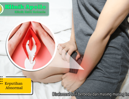 Simak! 7 Cara Atasi Keputihan Abnormal Wanita dengan Cepat