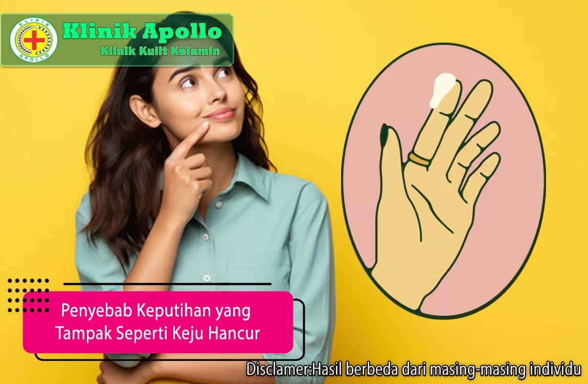 Ketahui penyebab keputihan yang tampak seperti keju hancur dengan pemeriksaan medis di Klinik Apollo Jakarta.