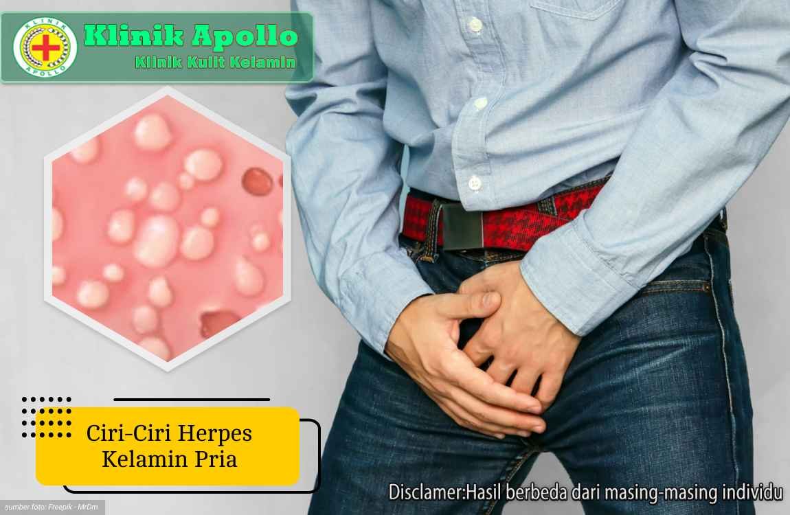 Ketahui ciri-ciri herpes kelamin pria dan lakukan penanganan di Klinik Apollo Jakarta.