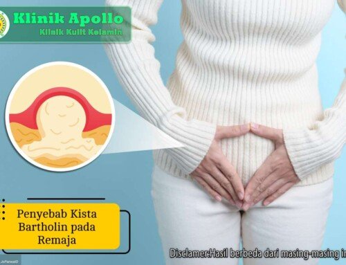 Cek! 5 Penyebab Kista Bartholin pada Remaja dan Pengobatannya