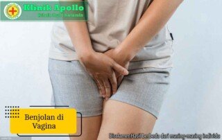 Ilustrasi Benjolan di Vagina Wanita.