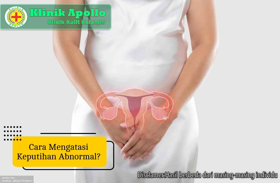 Ilustrasi Cara Mengatasi Keputihan Abnormal.