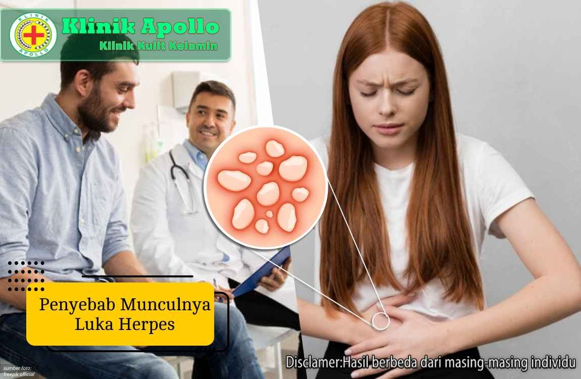 Ilustrasi Penyebab Munculnya Luka Herpes.