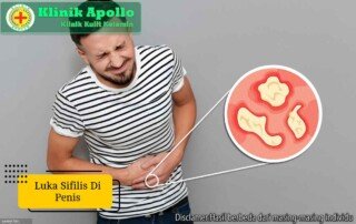 Ilustrasi Luka Sifilis di Penis.