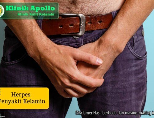 Cara Tepat Mencegah dan Mengobati Herpes Penyakit Kelamin
