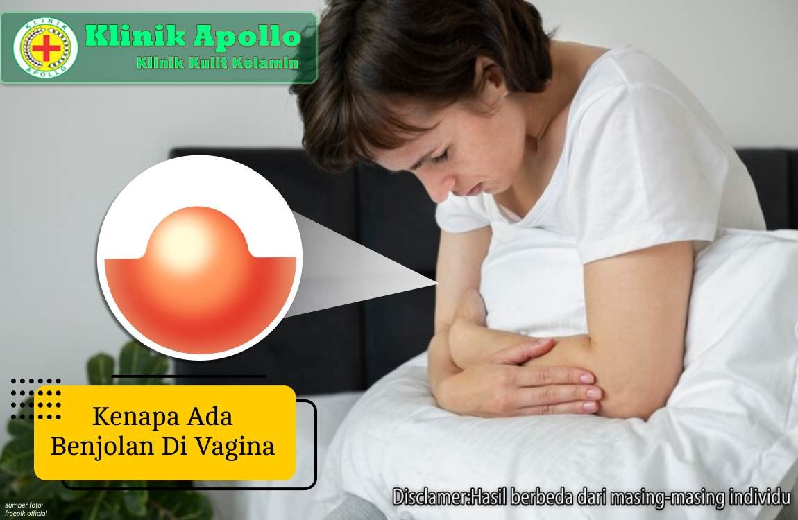 Ilustrasi Kenapa Ada Benjolan di Vagina.