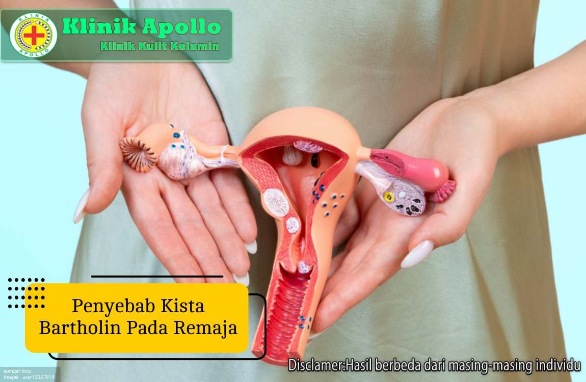 Ilustrasi Penyebab Kista Bartholin pada Remaja.