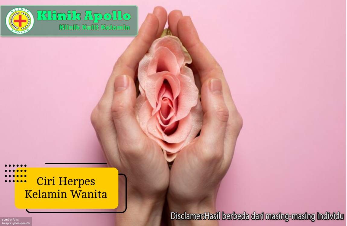 Ilustrasi Ciri Herpes Kelamin Wanita.