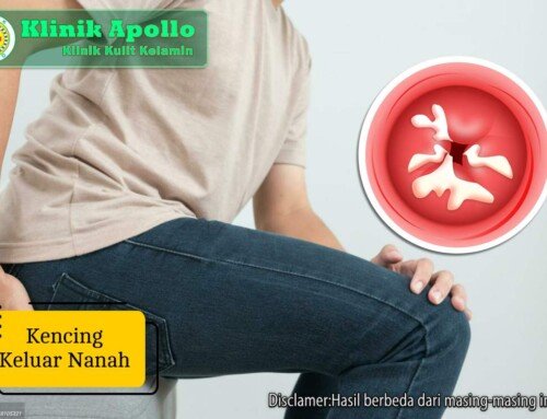 Kencing Keluar Nanah: Penyebab, Gejala, Pengobatan Tepat