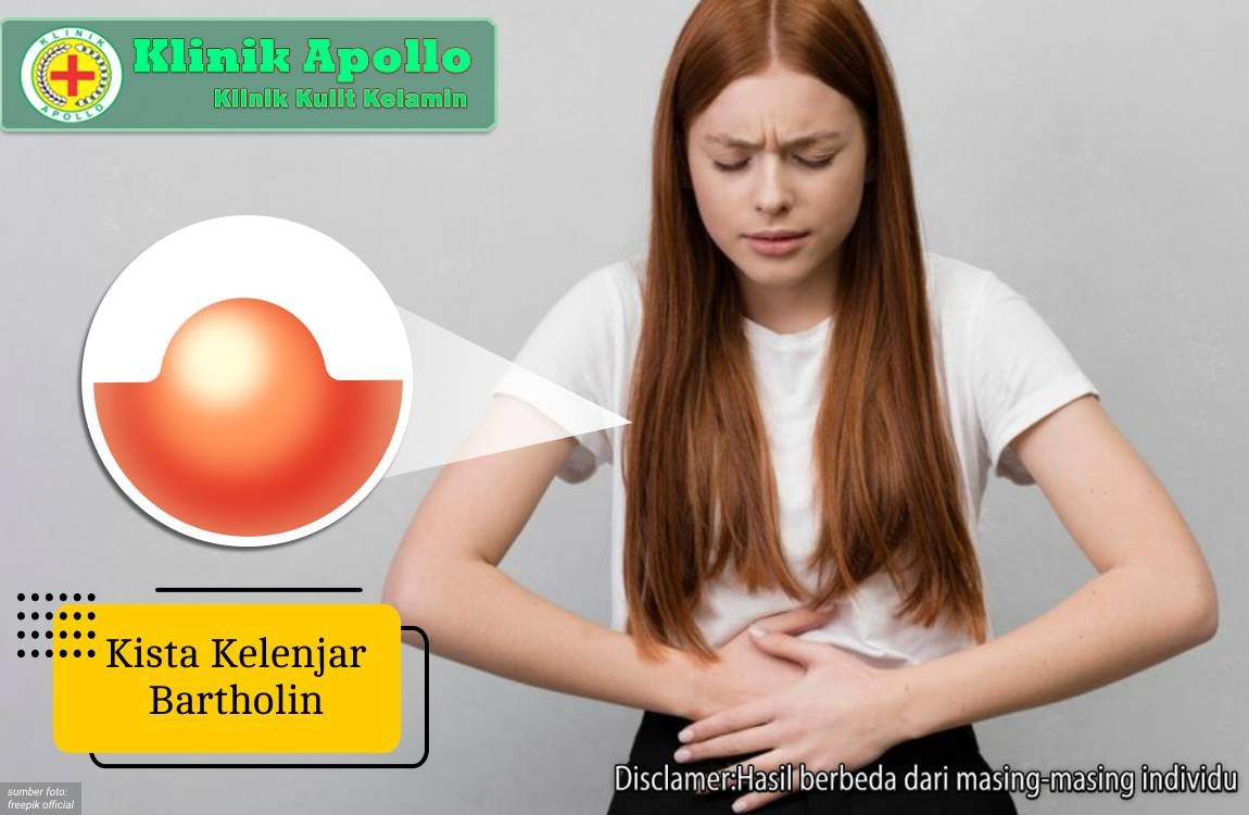 Ilustrasi Kista Kelenjar Bartholin.