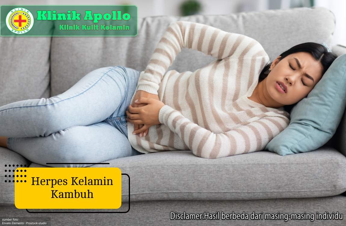 Ilustrasi Herpes Kelamin Kambuh.