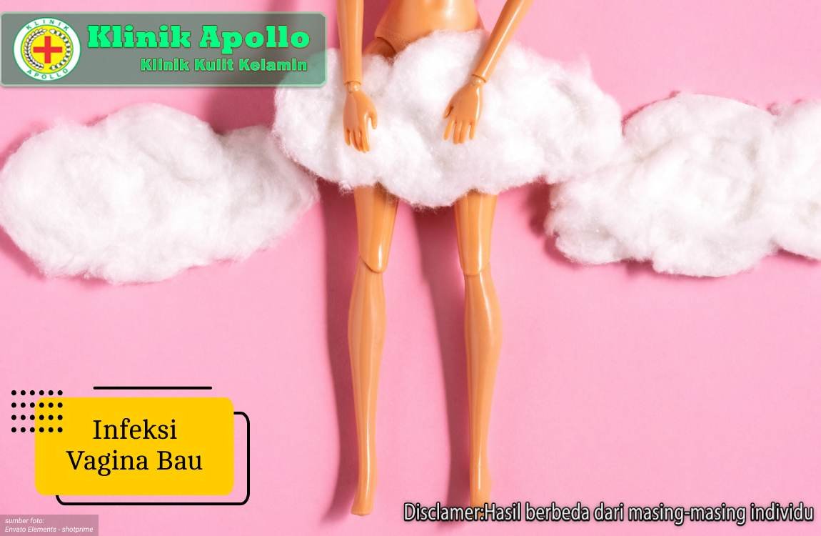 Ilustrasi Infeksi Vagina Bau.