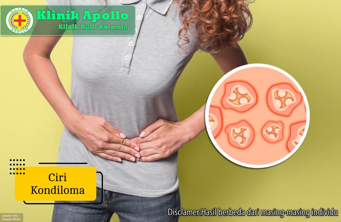 Ilustrasi Ciri Kondiloma.