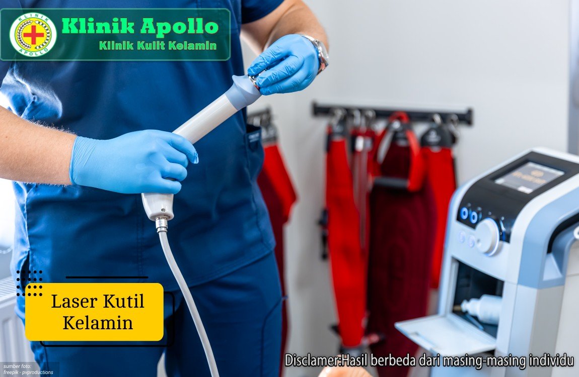 Ilustrasi Laser Kutil Kelamin.