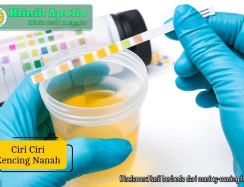 Waspada! Ini Ciri Ciri Kencing Nanah dan Risiko Jika Tidak Diobati