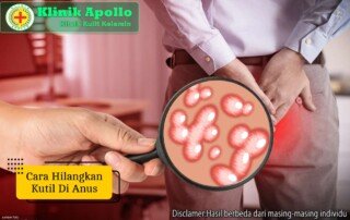 Ilustrasi cara Hilangkan Kutil di Anus.