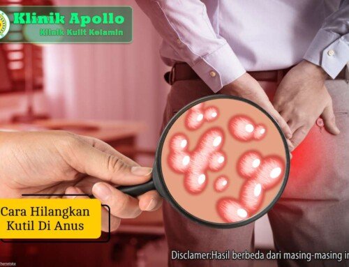 Cara Hilangkan Kutil di Anus yang Sering Kambuh, Apa Solusinya?