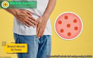 Ilustrasi Bentol Merah di Penis.