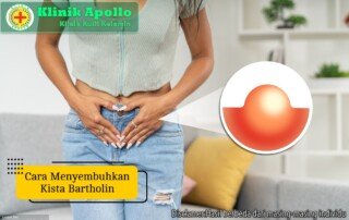 Ilustrasi Cara Menyembuhkan Kista Bartholin.