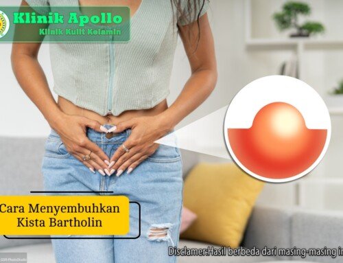Cara Menyembuhkan Kista Bartholin Tanpa Takut & Risiko Tinggi