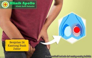 Ilustrasi Benjolan di Kantung Buah Zakar.
