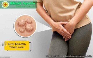 Ilustrasi Kutil Kelamin Tahap Awal.