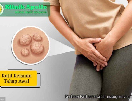 Kutil Kelamin Tahap Awal Akibat HPV: Gejala dan Pengobatannya