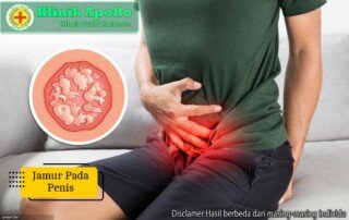Ilustrasi Jamur pada Penis.