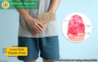 Ilustrasi Lecet pada Kepala Penis.
