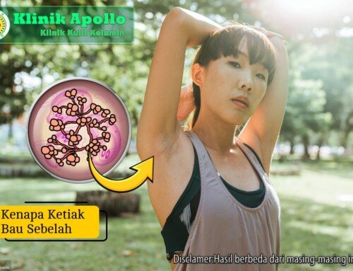 Kenapa Ketiak Bau Sebelah? Ini 4 Penyebab Utamanya