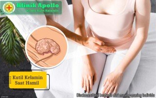 Ilustrasi Kutil Kelamin Saat Hamil.