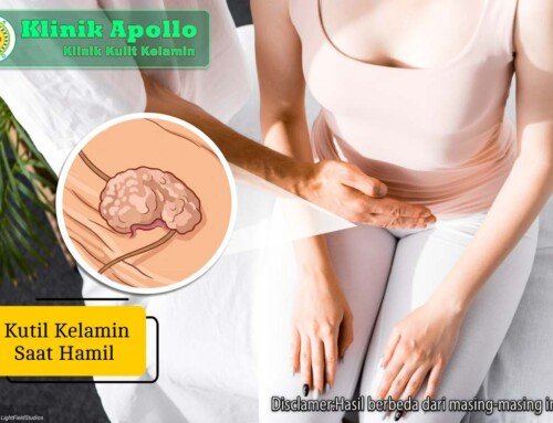 Kutil Kelamin Saat Hamil: Risiko dan Penanganannya
