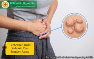 Ilustrasi Perbedaan Kutil Kelamin dan Jengger Ayam.